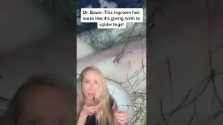 Dermatologist on massive ingrown hair 