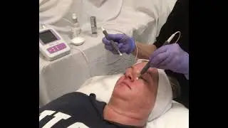 Cotton Tip Probe Treatment