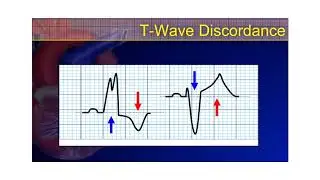 The 12-Lead ECG Course - STE-Mimics Part 2