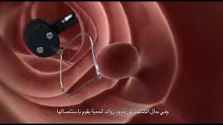 Colonoscopy Procedure: What Is a Colonoscopy Screening and How Its Done?