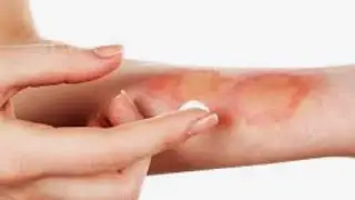 Brûlure 1er degré superficiel ضماضه للحروق من الدرجه الأولى