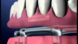Implant Supported Dentures - Miskin Ajax Dental