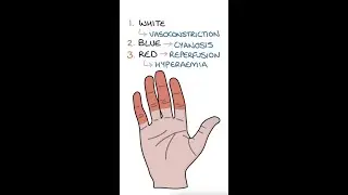 Raynaud's Disease 