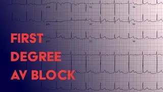 First Degree AV Block -  EKG (ECG) Interpretation
