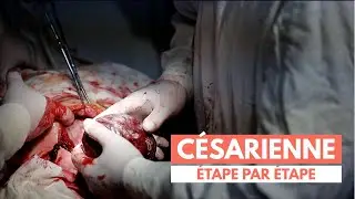 La césarienne étape par étape | Bien vous préparer à une césarienne