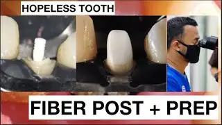 Fiber Post Placement + Preparation Hopeless Tooth | General Dentist Griya RR