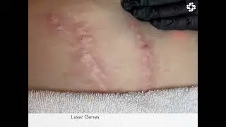 STRETCH MARKS, MEET YOUR MATCH!