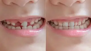 How to fix Broken Teeth Photoshop Editing Tutorial
