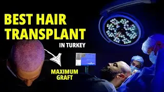 Best hair transplant 2025 #hairtransplant