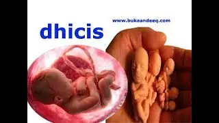 dhiciska waxa sababa sida lagu garto iyo daweyntiisa