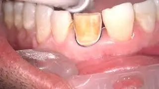 Prep Discolored Central Incisor for Laminate