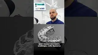 Брекеты или элайнеры #брекеты #shorts #элайнеры