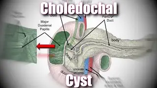 Choledochal Cyst