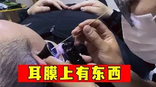 耳朵里面有东西，紧贴耳膜，成功取出