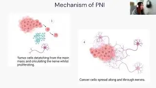 A Mathematical Model of Perineural Invasion in Pancreatic Ductal Adenocarcinoma...