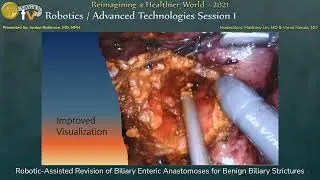 Robot Revisional Hepaticojejunostomy for Benign Biliary Strictures