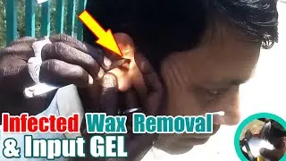 ►Huge White Wax Removal at Roadside II Oily Chunk Wax Removing ASMR BD II Got Super Relaxation