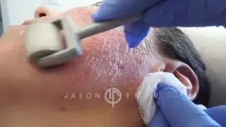Dermaroller / Microneedling Acne Scars / Skin Resurfacing / Los Angeles, California