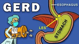 Gastroesophageal Reflux Disease (GERD)