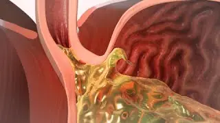 Funduplicatura Pediátrica para la Enfermedad del Reflujo Gastroesofágico (GERD)