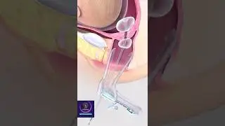 Cervical Dilation & Curettage - Cervix Opening with Balloon 