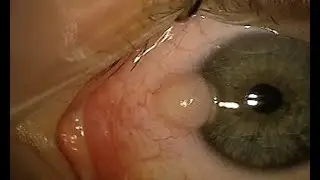 Removal of small limbal dermoid