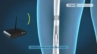 Implantable actuator / Clou d'allongement intramédullaire motorisé - MPS Microsystems