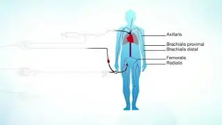 Setup guide PiCCO   Video