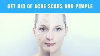 How to Get Rid Of Acne Scars and Pimple - HealthyVids