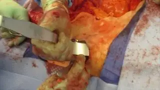 Dumanian: Components release through lateral incisions