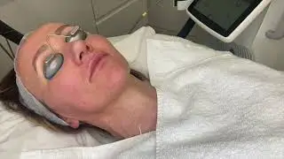 Fotona SP Dynamis rosacea treatment training video