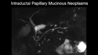 Intraductal Papillary Mucinous Neoplasms