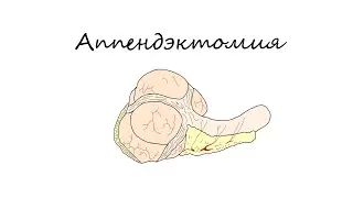 Аппендэктомия I Appendectomy