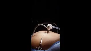 How to estimate length of bowel using retractors in laparoscopic gastric bypass #shorts