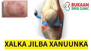 Xalka jilba xanuunka iyo Duritaanka kala goysyada _intra-articular injection