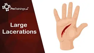 Large Lacerations