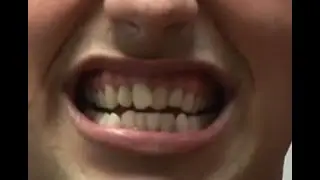 INVISALIGN - Pro Tips & What They're Not Telling You!