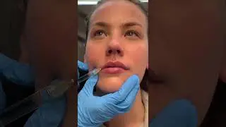 You Don't Need to Be Scared of Lip Filler when You Have an Experienced Injector!