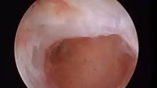 Asherman Syndrome Hysteroscopic Adhesiolysis, Shawki Jr