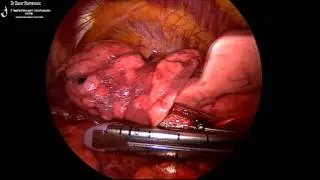 VATS Right Upper Lobe Anterior (S3) Segmentectomy