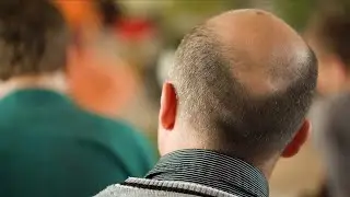 Tratamiento Natural Para La Caida Del Cabello - Remedios Para La Caída Del Cabello Por Estrés