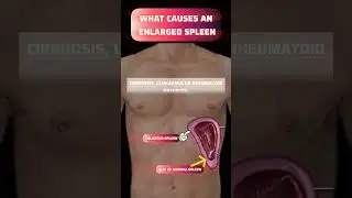what causes an enlarged spleen - Splenomegaly #spleen