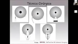 7° webinar Adapt   Tecnologia em lentes fácicas Artisan ArtiFlex