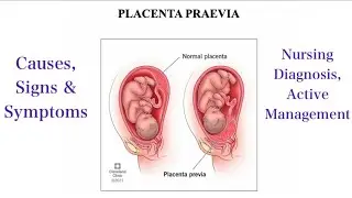 Placenta Previa| Causes | Symptoms | Diagnosis | Management | Sandhya OBG Study Point