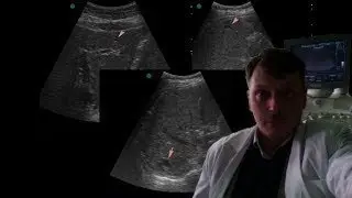 Abdominal ultrasound - Liver cysts