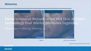 Aerolase Laser for Melasma Treatment - Toronto and Richmond Hill