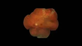 Horseshoe retinal tear with laser barrage