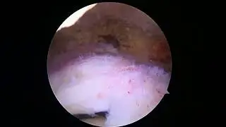 Rotator cuff repair with Biobrace Graft and Biceps Tenodesis 4 20 23 KG