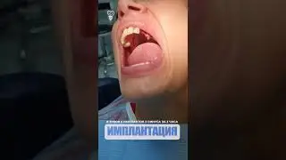 8 зубов 6 имплантов 2 синуса за 3 часа. 8 teeth 6 implants 2 sinuses in 3 hours.