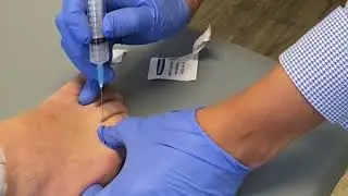 Steroid injection for Morton’s Neuroma